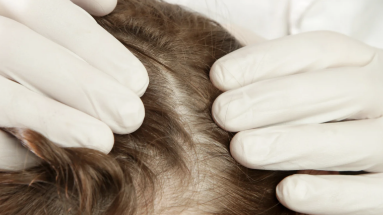 Best Hair Loss Doctor Near Bethesda, Maryland for Thinning Hair